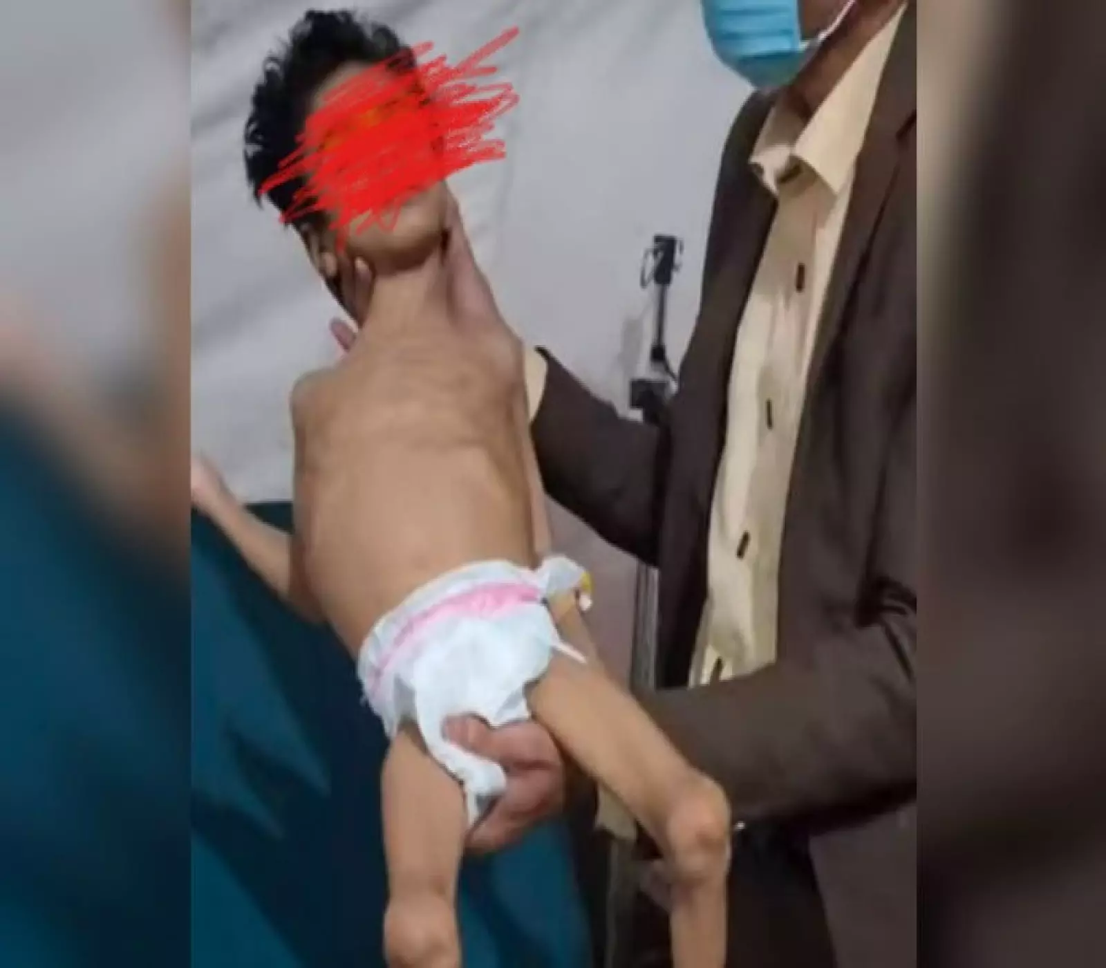 "ليست من غزة ولا من أفريقيا": صور صادمة من حجة توثق مأساة طفل يمني أرهقه الجوع بفعل سياسة التجويع ! (شاهد)