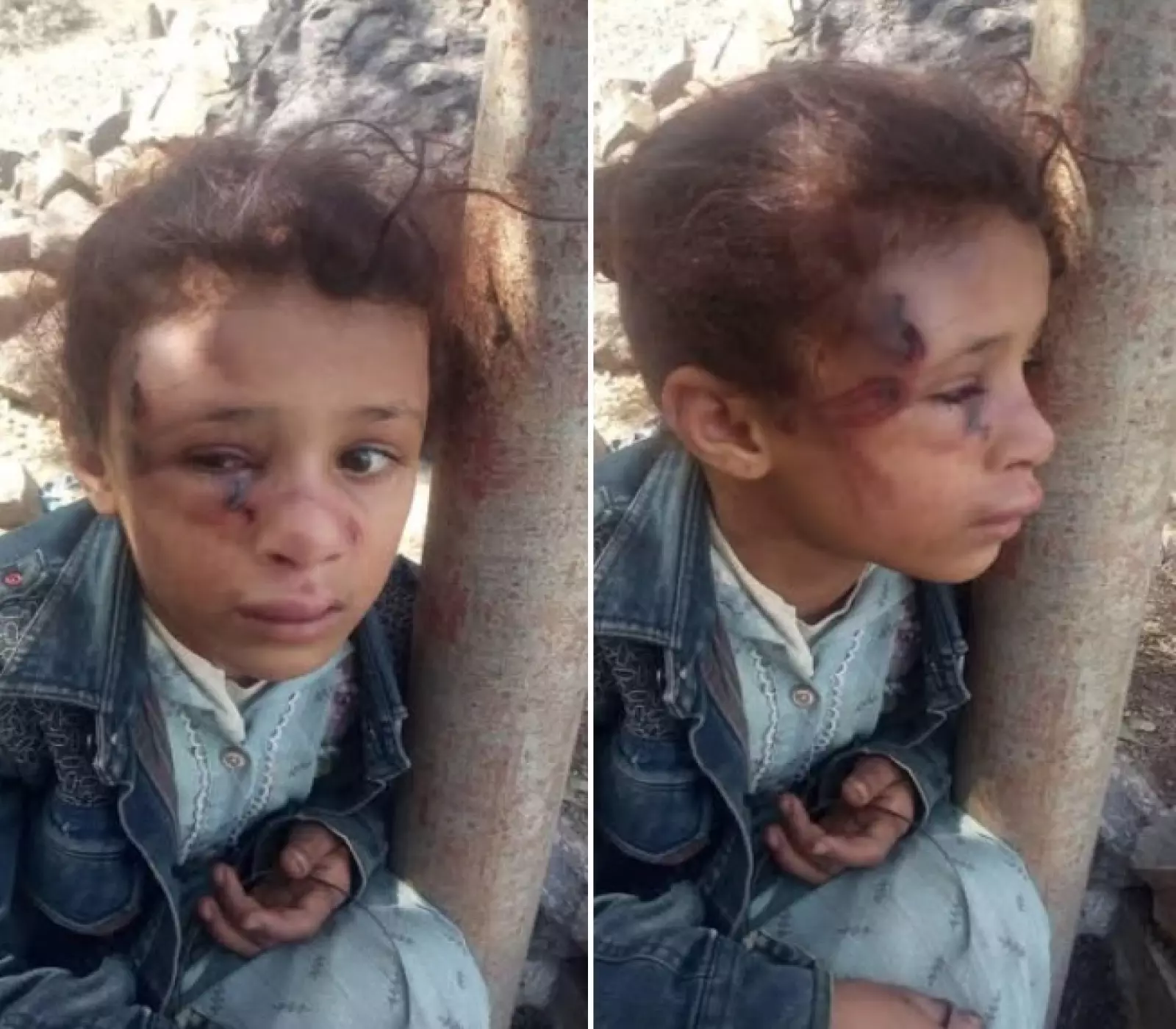 طفلة يمنية ضحية اعتداء وحشي بتعز