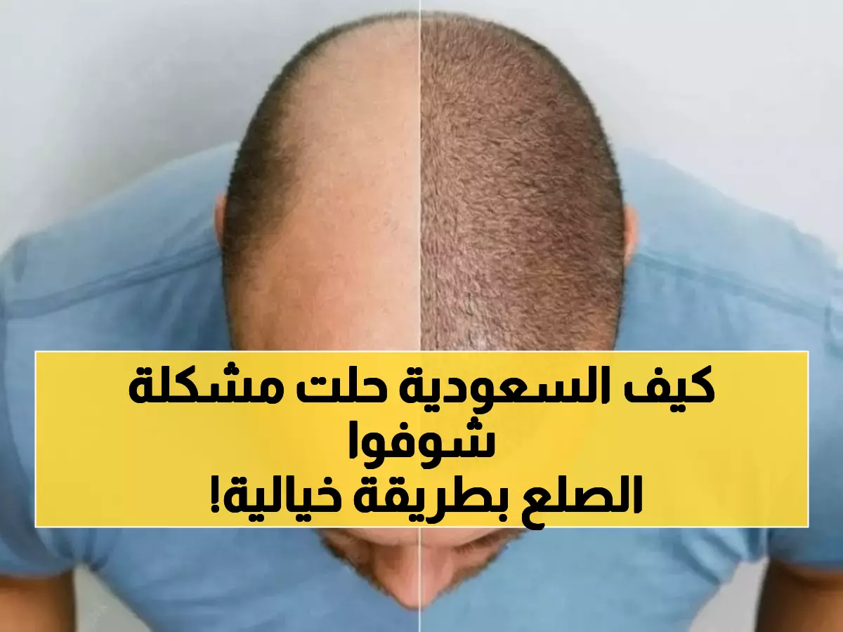 عاجل: ثورة الروبوتات السعودية تقضي على الصلع نهائياً - نجاح 95% وشفاء في 3 أيام فقط!