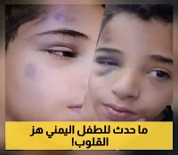 القصة الكاملة للطفل اليمني "ضياء" الذي فعل خيراً فوجد نفسه يصارع الموت بسببه..ما الذي حدث!؟ (صور)
