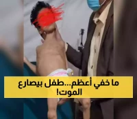 "ليست من غزة ولا من أفريقيا": صور صادمة من حجة توثق مأساة طفل يمني أرهقه الجوع بفعل سياسة التجويع ! (شاهد)