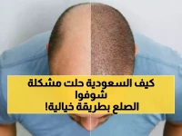 عاجل: ثورة الروبوتات السعودية تقضي على الصلع نهائياً - نجاح 95% وشفاء في 3 أيام فقط!