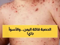 عاجل: اليمن تتصدر عالمياً بكارثة الحصبة... 23 ألف إصابة و214 وفاة والأرقام الحقيقية أكثر رعباً!